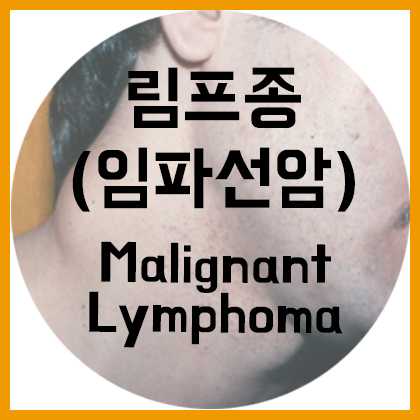  [목] 악성 림프종(Malignant lymphoma)