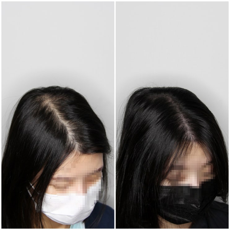  SMP 두피문신 하기 전 꼭 알아야 할 사항들