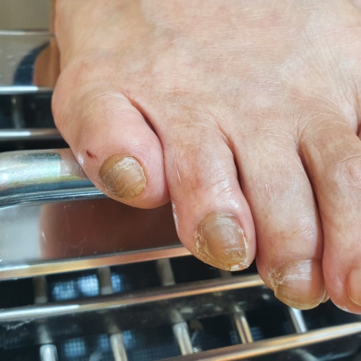  부천 발각질, 무좀발톱, 발톱무좀 케어는 더헤드!