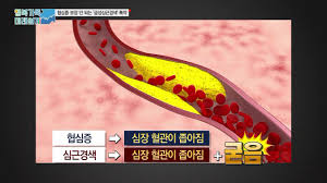  협심증 심근경색 원인주요증상 약물종류치료 심전도EKG초음파 니트로글리세린사용법 관상동맥스텐트삽입 간호과정케이스