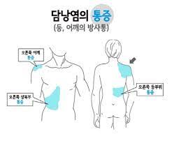  간호학 담낭염 원인주요증상 급성만성비교 약물수술치료 우상복부통증 담석증 담낭절제술 간호과정중재