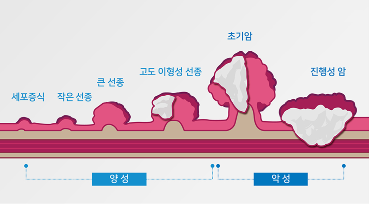  (               ) 으로 대장암을 90% 예방할 수 있습니다  : 강북구 대장내시경 잘하는 내일내과