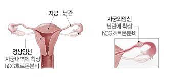  자궁외임신 원인 주요증상 대표부위 cullen징후 진단검사 수술치료 간호중재 합병증예후 여성간호학공부