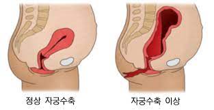  산부인과입원 임산부준비 정상분만과정 제왕절개 자연분만비교 힘주기통증 산모주의사항 출산합병증