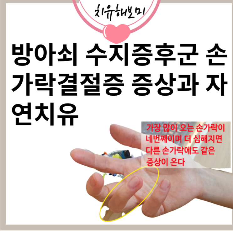 방아쇠 수지증후군 손가락결절증 증상과 자연치유