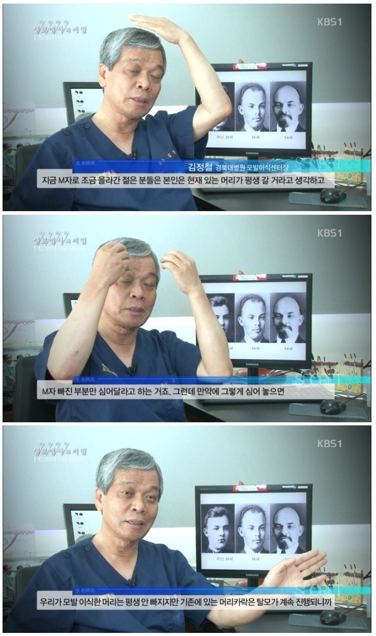  모발이식의 진실