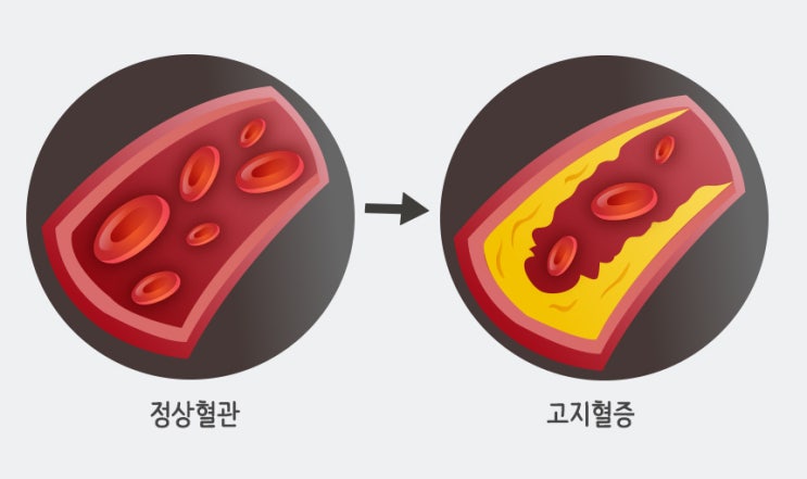  고지혈증과 보험