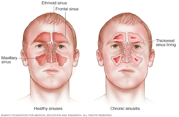 만성 부비동염 Chronic sinusitis 부비동염, 축농증