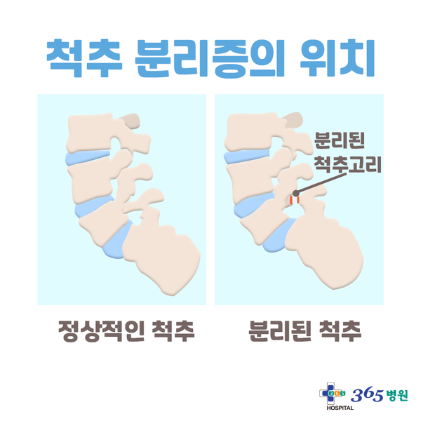  [창원마산 척추관절 디스크 365병원] 척추분리증