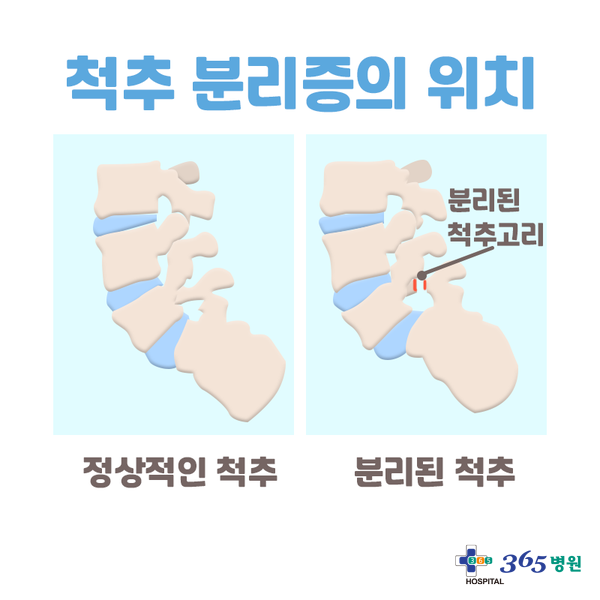 [창원마산 척추관절 디스크 365병원] 척추분리증