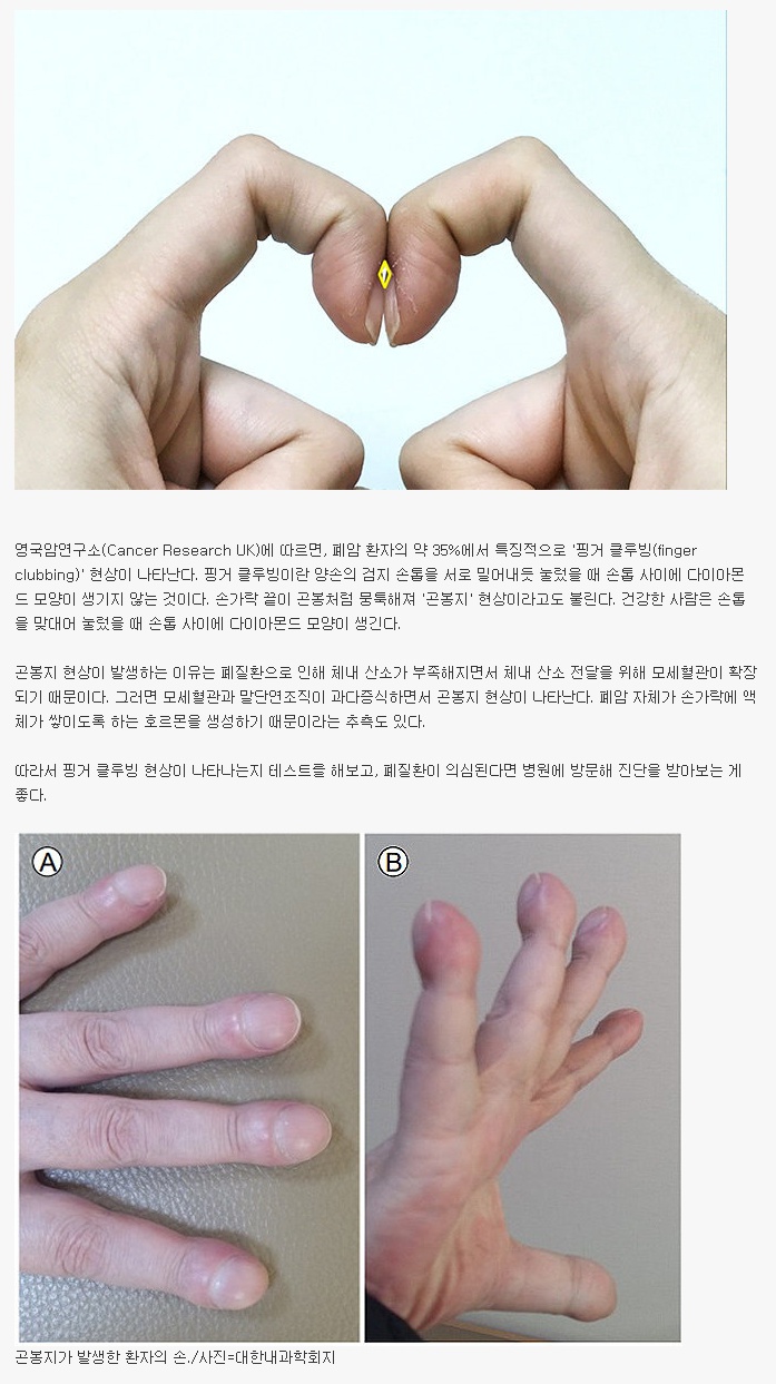  폐암 위험 신호