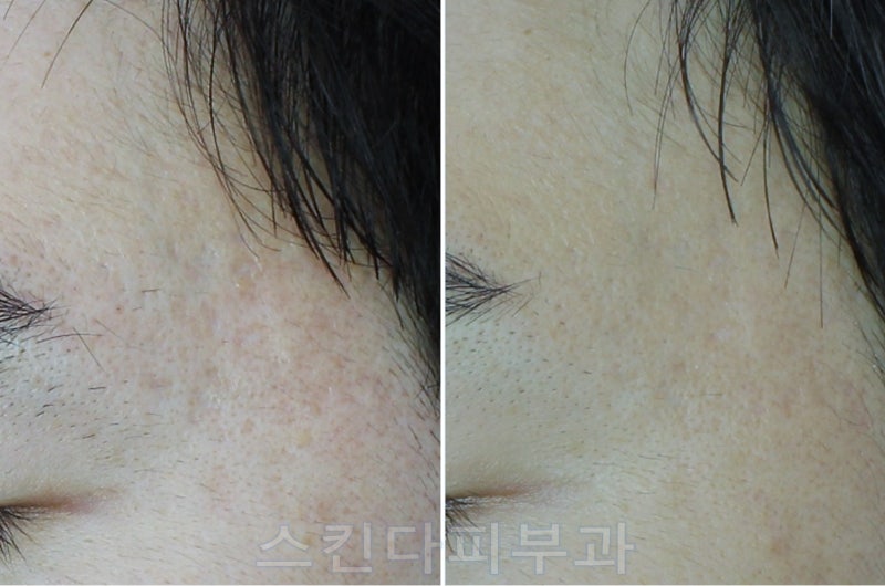 관자놀이 여드름 제거 후기 7