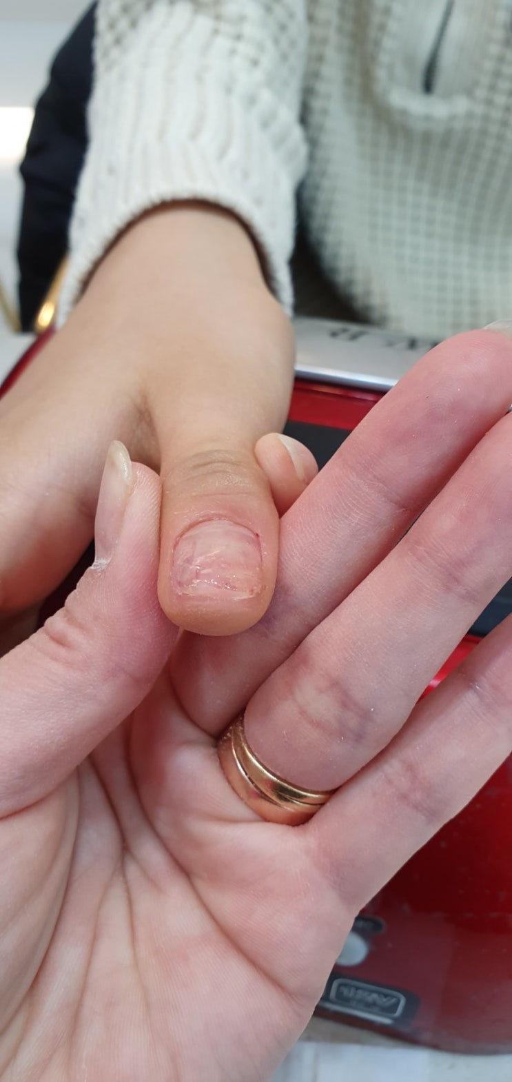  광주 문제성손톱 손톱관리 꼼꼼한 페디네일 방문기!