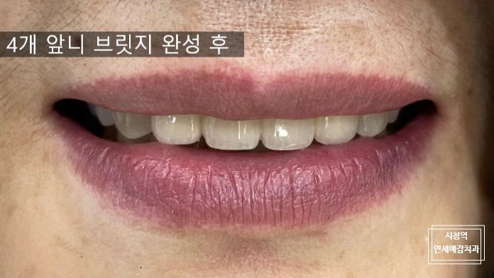  [치과브릿지]남대문치과/깨지고 오래된 앞니브릿지 교체케이스