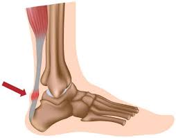  [서래마을PT] 흔한 아킬레스 건 통증의 원인..아킬레스 건병증(Achilles tendinopathy)