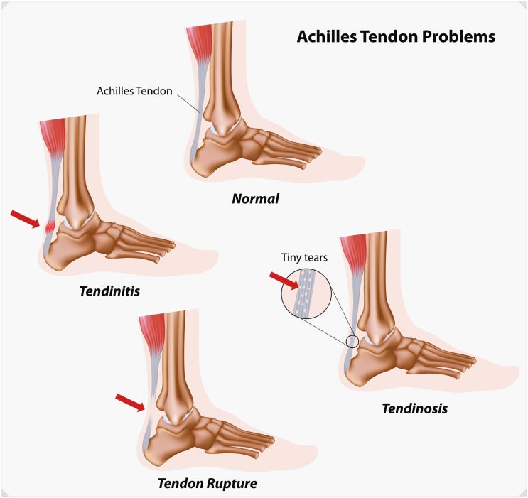 아킬레스건염 / 건병증 수술? 정형외과 전문의가 설명드립니다.