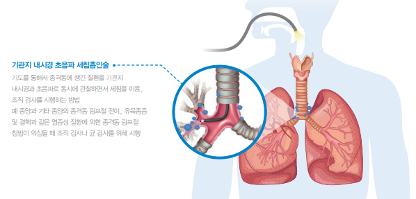 암 검사정보 - 기관지 내시경 초음파 세침 흡인술 (EBUS-TBNA)