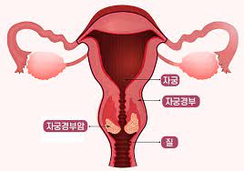  자궁경부암 원인부위 대표증상 진단검사 항암수술치료 생존률예후 HPV인유두종바이러스예방주사 질출혈골반통