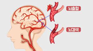  뇌졸중뇌경색 4가지종류 원인초기증상 약물수술치료 셀프자가진단 허혈혈전색전출혈 전구증상 간호중재과정