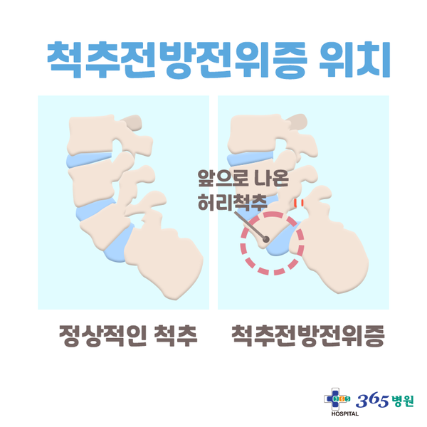  [창원마산 척추관절 디스크 365병원] 척추전방전위증