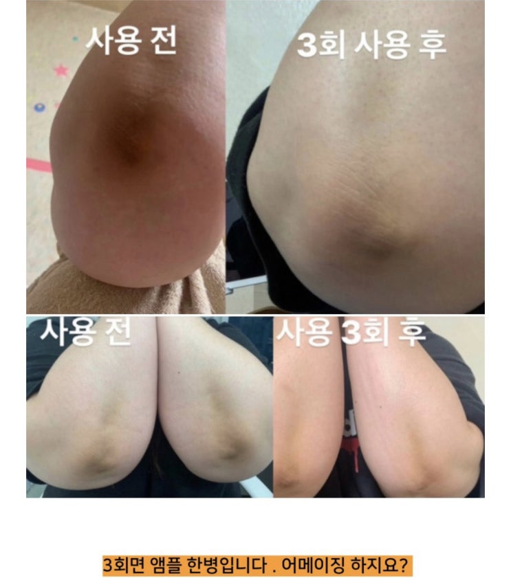  <오늘 마감 > 말못할 고민 / 바디 착색 관리의 ️끝판왕️ 프로모이탈리아 핑크닝 앰플hurry up !