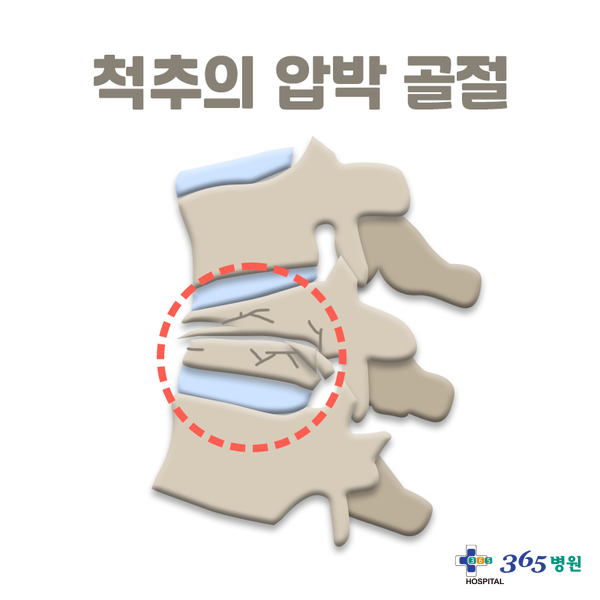  [창원마산 척추관절 디스크 365병원] 척추압박골절