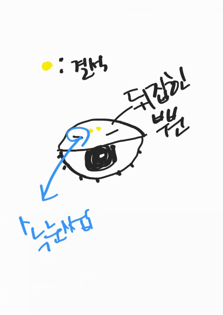  눈이 갑자기 따가운 이유