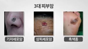  피부암 원인부위 모양특징 증상종류 악성종양조기진단검사 흑색종궤양반점 사망률예후전이 자외선노출