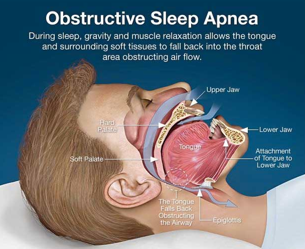 코골이 Snoring, 수면무호흡증 Obstructive sleep apnea