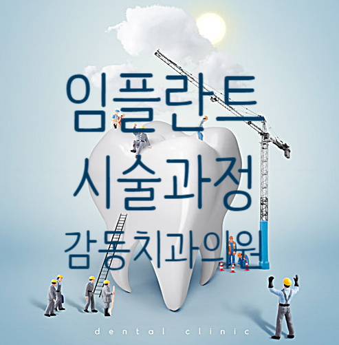  임플란트 시술 과정 정리