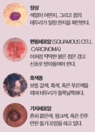  피부암 9가지치료방법 장단점 피부이식절제술 전기소작술 방사선항암치료부작용 피부암예후합병증
