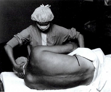  척추마취는 뭔가요?-(2) 사용하는 약제(Bupivacaine 외), 지속시간(회복 시간), 주의사항