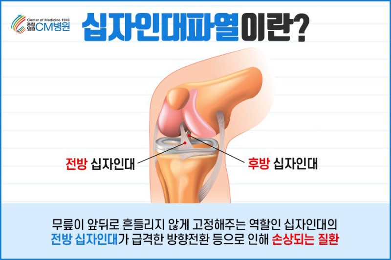 대화역 정형외과, 무릎십자인대파열