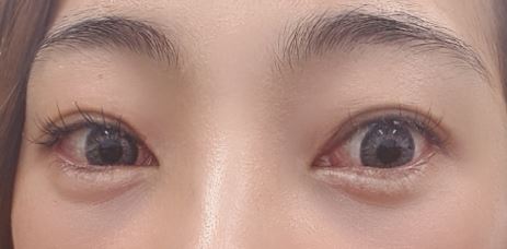  눈밑지방재배치후기 다크써클과 이별하는 방법