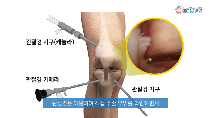 대화역 정형외과, 무릎십자인대파열 4