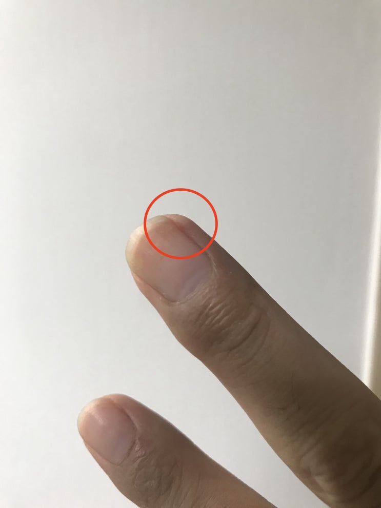  조갑주위염 (생인손) 치료기 5 - 뒤늦게 올리는 완치 후기