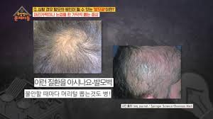  발모광 원인증상 불안심리특징 정신과치료 머리카락뽑는습관 대처방법 강박증발모벽 원형탈모