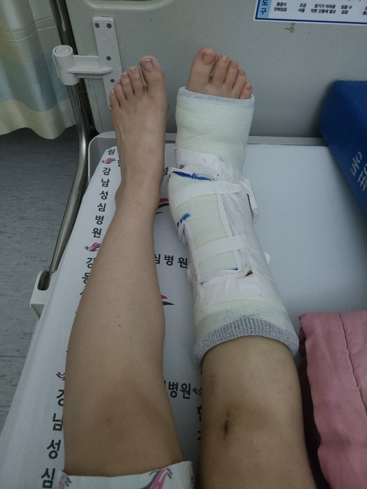  [수술후기록] 다리골절수술 후 사진일지(17주차) / 재수술후 다시 깁스