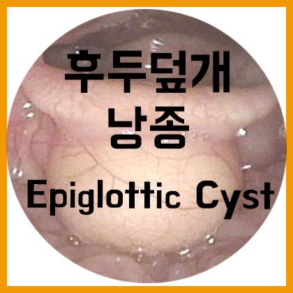  [목] 후두(덮)개 낭종(Epiglottic cyst)