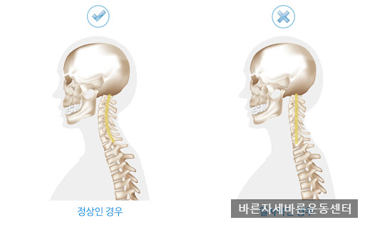  [서래마을PT] 일자목(Neck Flat) 에 대하여...