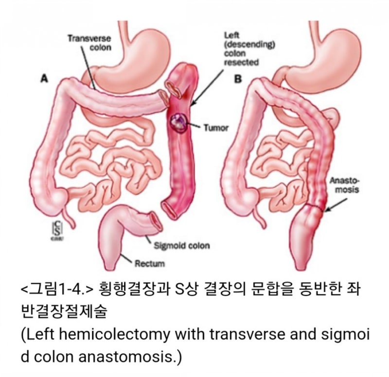 Laparoscopic exploration & Exploratory laparotomy GS hartmann op ...