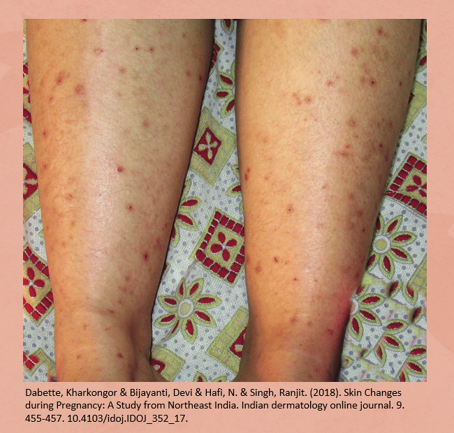 임신 중 다리 두드러기 증상 재발 방지 소잠한의원