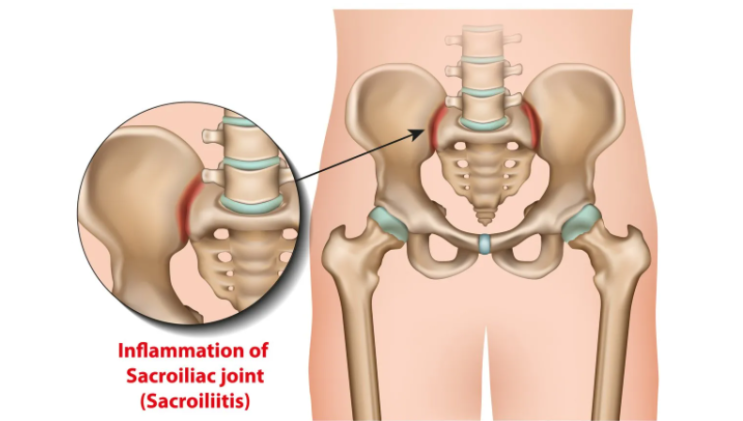  [서래마을 PT] 잘못된 자세로 인한천장관절(SI joint) 통증