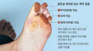  굳은살 티눈 사마귀 무좀 비교차이점부위 증상특징 예방치료 의료용깔창패드 걸을때발통증 바이러스곰팡이균