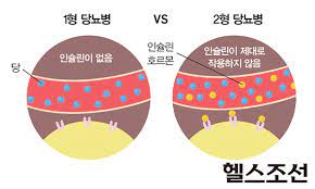  소아당뇨병 원인병태생리 의심증상 1형2형당뇨비교 인슐린치료 식단관리 예후합병증 간호진단과정