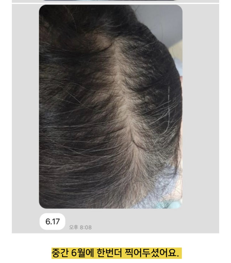  "후기가 인증" 탈모고민! 해결책은 베버힐 헤어토닉→→