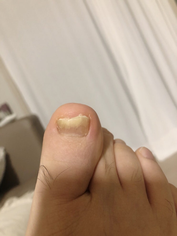  발톱무좀 핀포인트 4회차 치료