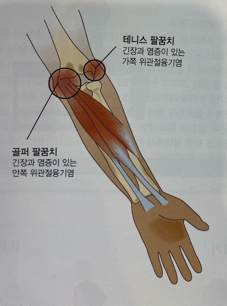 [이수역필라테스] 팔꿈치와 손목 손상 관련 편