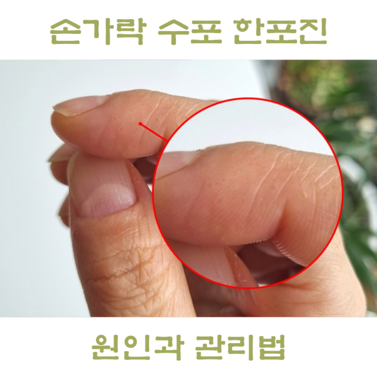 손가락 수포 한포진 원인, 연고 아무거나 발라도 될까?