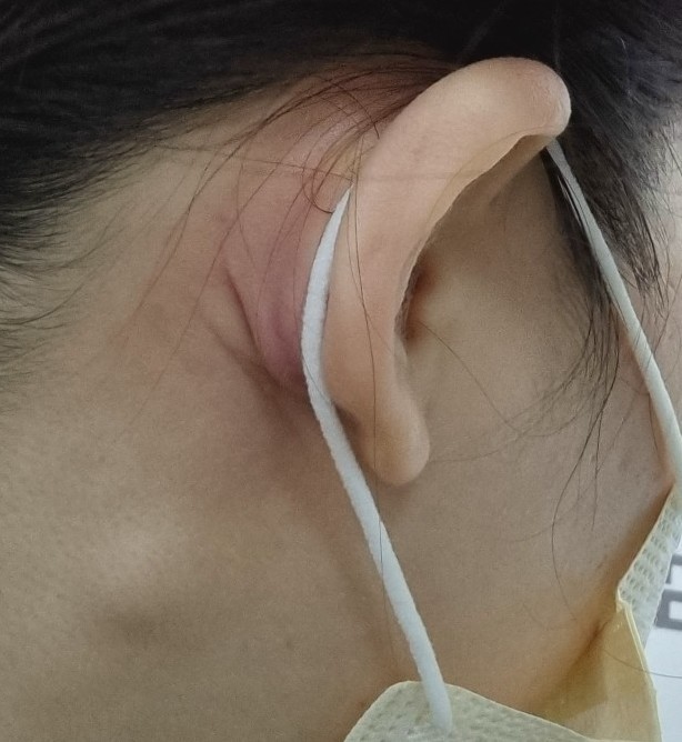 귀뒤 피지낭종 제거수술후기 : 네이버 블로그